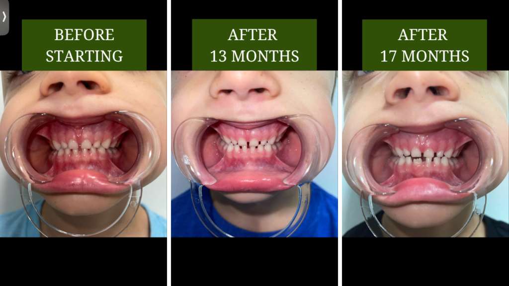 BEFORE AND AFTER 17 MONTHS N'S FRONT TOOTHPILLOW