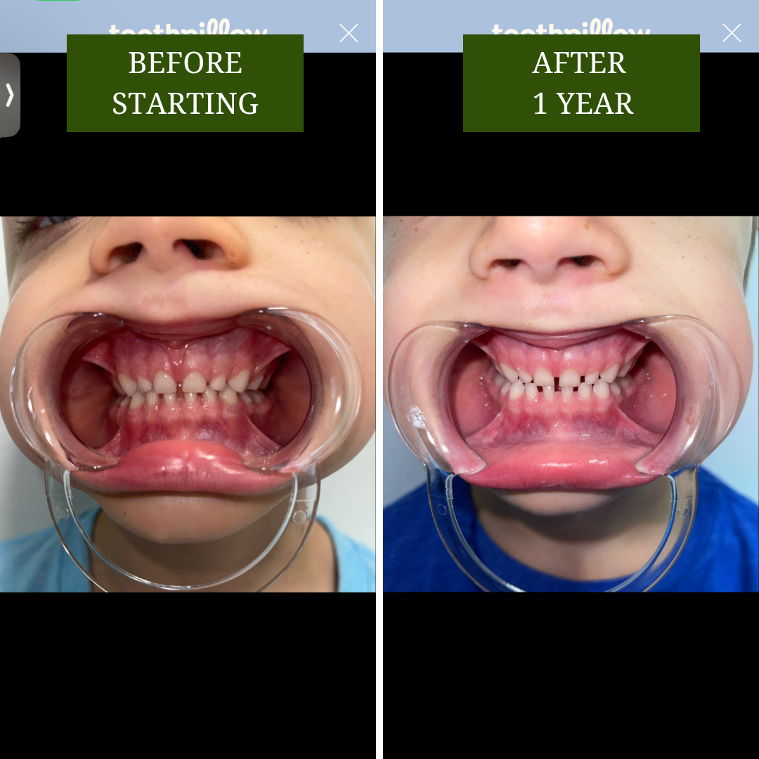 Toothpillow before and after using it for 1 year