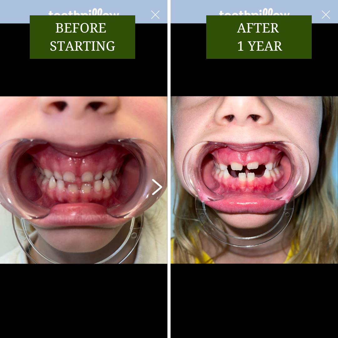 Toothpillow before and after using it for 1 year